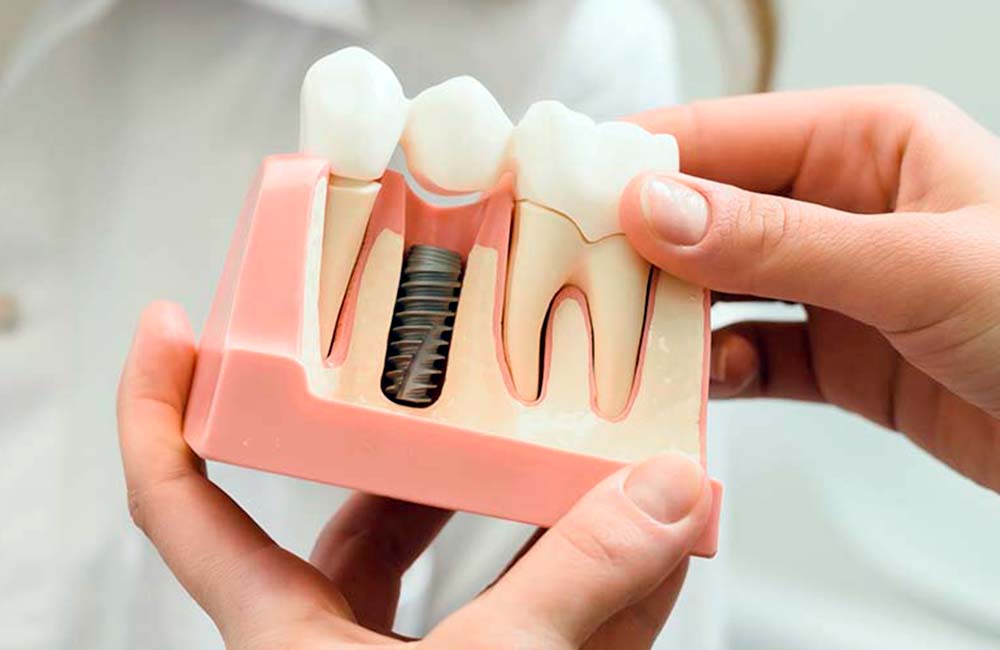 Terapia - Impianti dentali