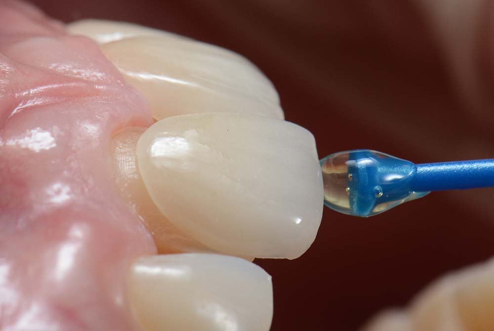 Faccette biocompatibili - Studio Odontoiatrico Fusco&Teodori - Dentisti a Latina Faccette biocompatibili - Studio Odontoiatrico Fusco&Teodori - Dentisti a Latina